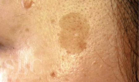 老人性色素斑（いわゆる一般的なシミ）