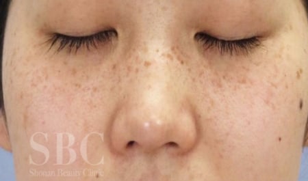 そばかす（雀卵斑）