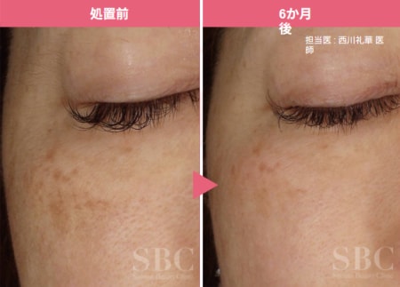 ピコトーニング