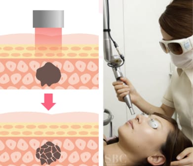 メラニン色素だけを選択的に破壊する治療