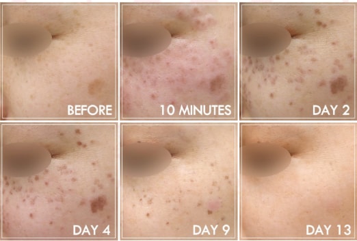 シミ取りのダウンタイムは