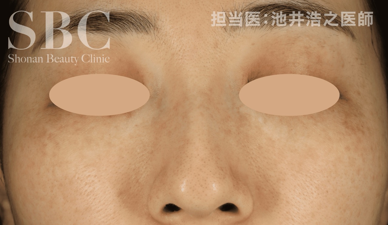 IPL光治療（シミ・小じわ改善）全顔3周＋韓国スキンブースター※初診料込 医療法人松本医院｜ライムライト（fotobright）｜光治療機器で高い治療