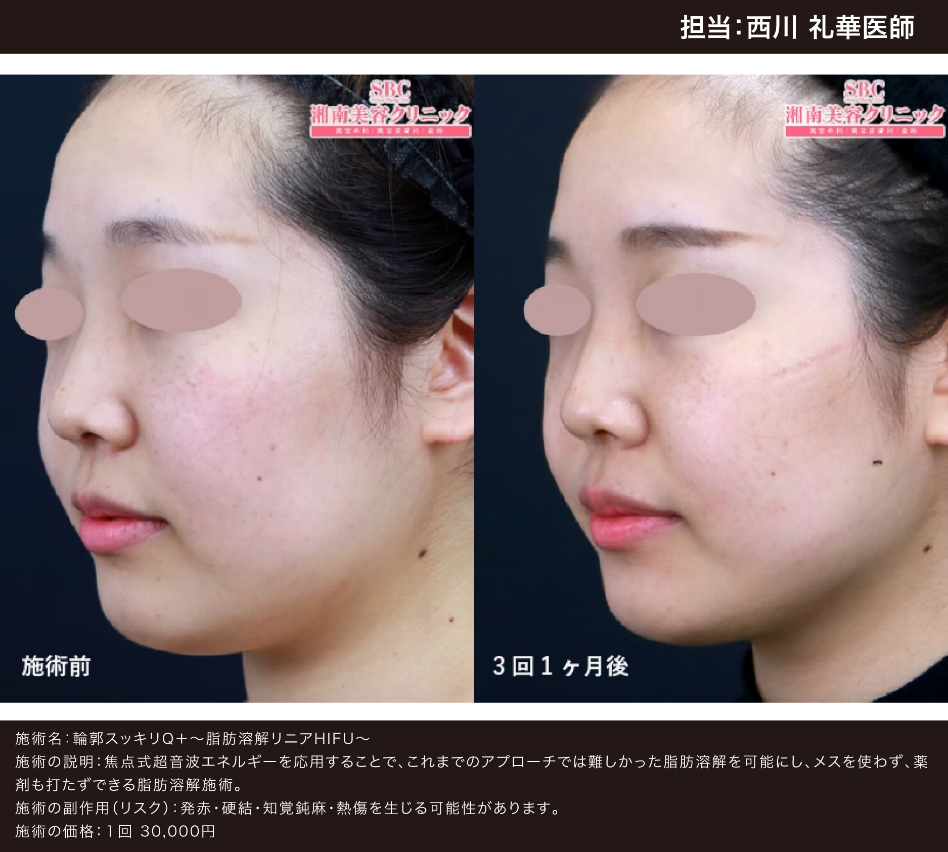 手遅れになる前に】たるみ改善で5歳若返る？！自然な若返りなら新宿本 