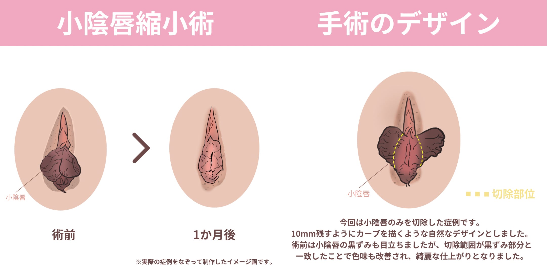 黒ずみ しょう いん しん 切除 症例 写真