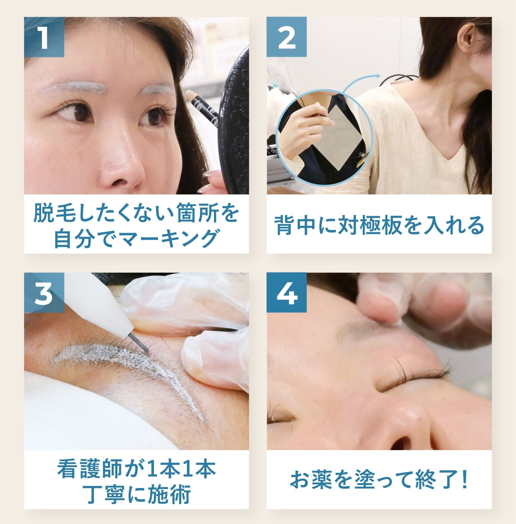 ニードル 脱毛 と は