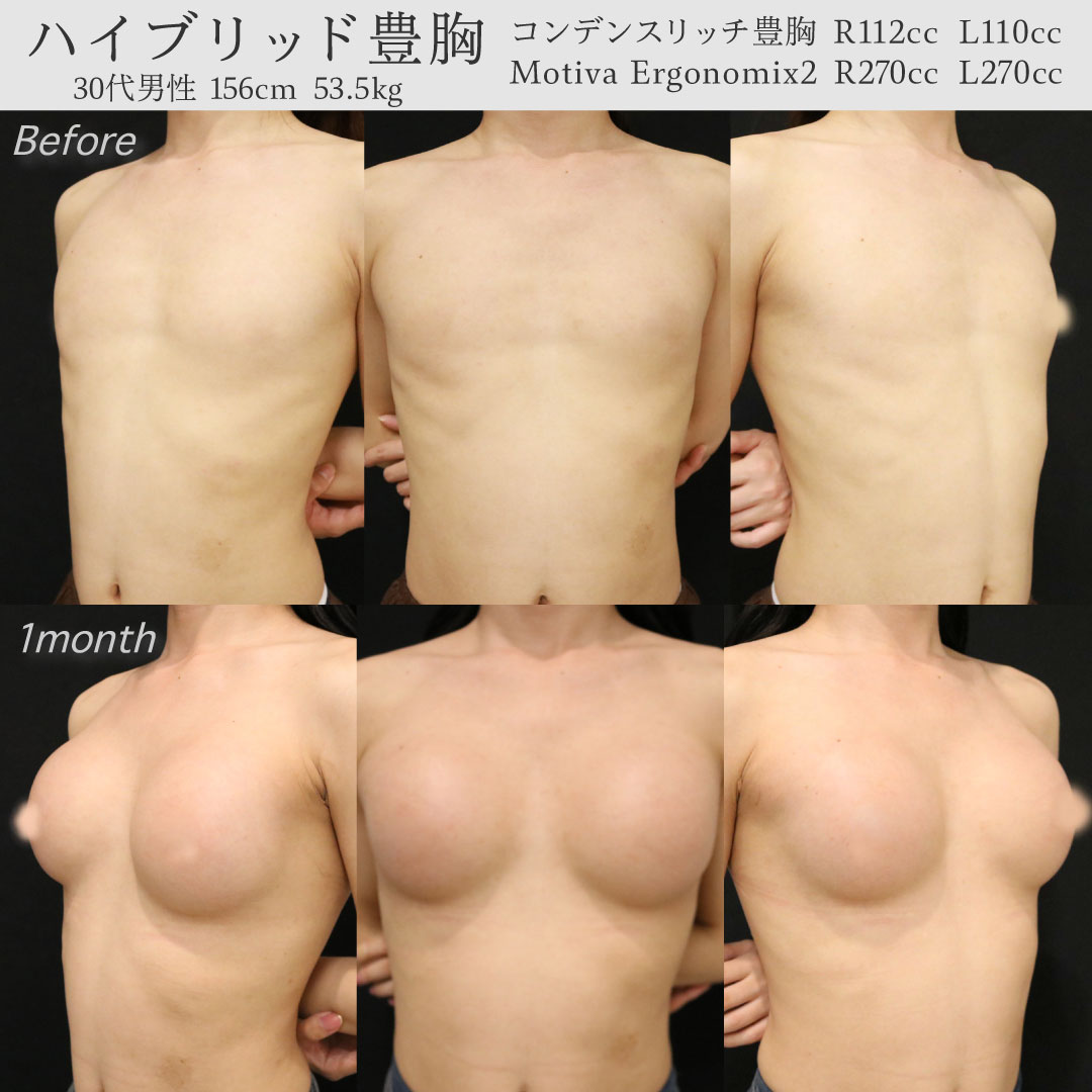 男性 豊 胸