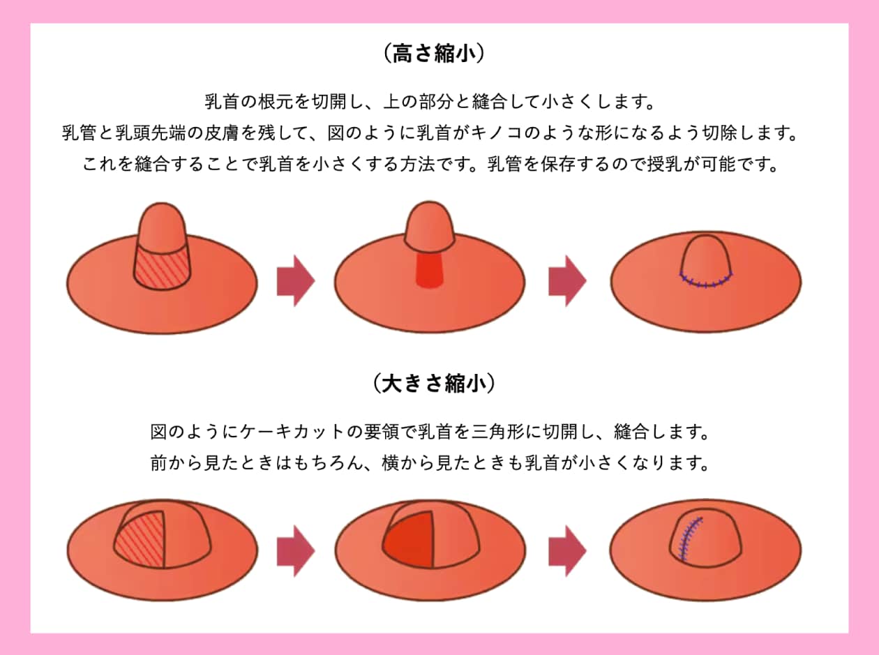 成長中　乳首 乳頭の大きさ・色味、乳輪のブツブツ】気になる方必見！改善方法や施術についてあやの先生が詳しくお教えします！ - 新宿本院