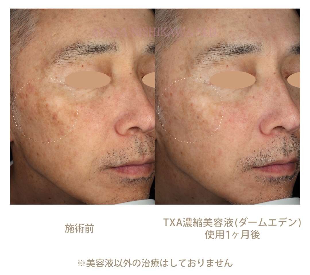 レモンユーカリ】ダームエデン TXA 濃縮美容液 10ml 湘南美容外科 TXA 