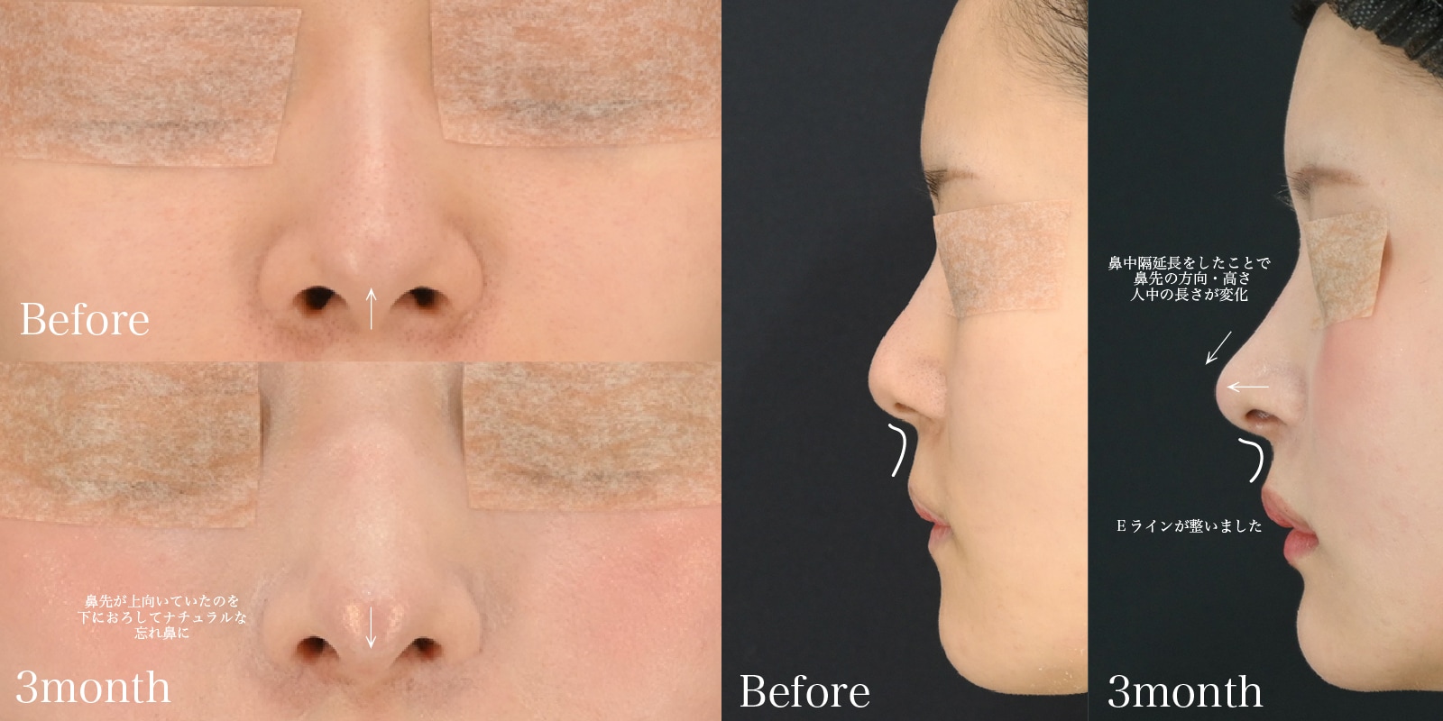異物ではなく、自分の組織で”──メッシュ挿入後の鼻をナチュラルに整える中度修正 - 新宿本院, image size:1600x800