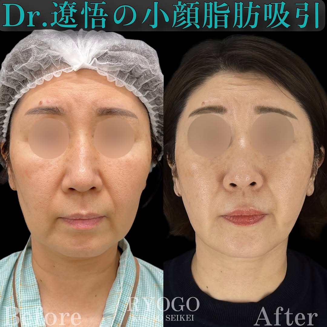 症例写真③【年齢で輪郭を諦めたくない人へ】