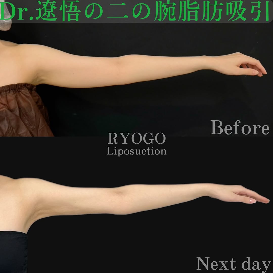 症例写真④【どんな服も着こなせる華奢腕に】