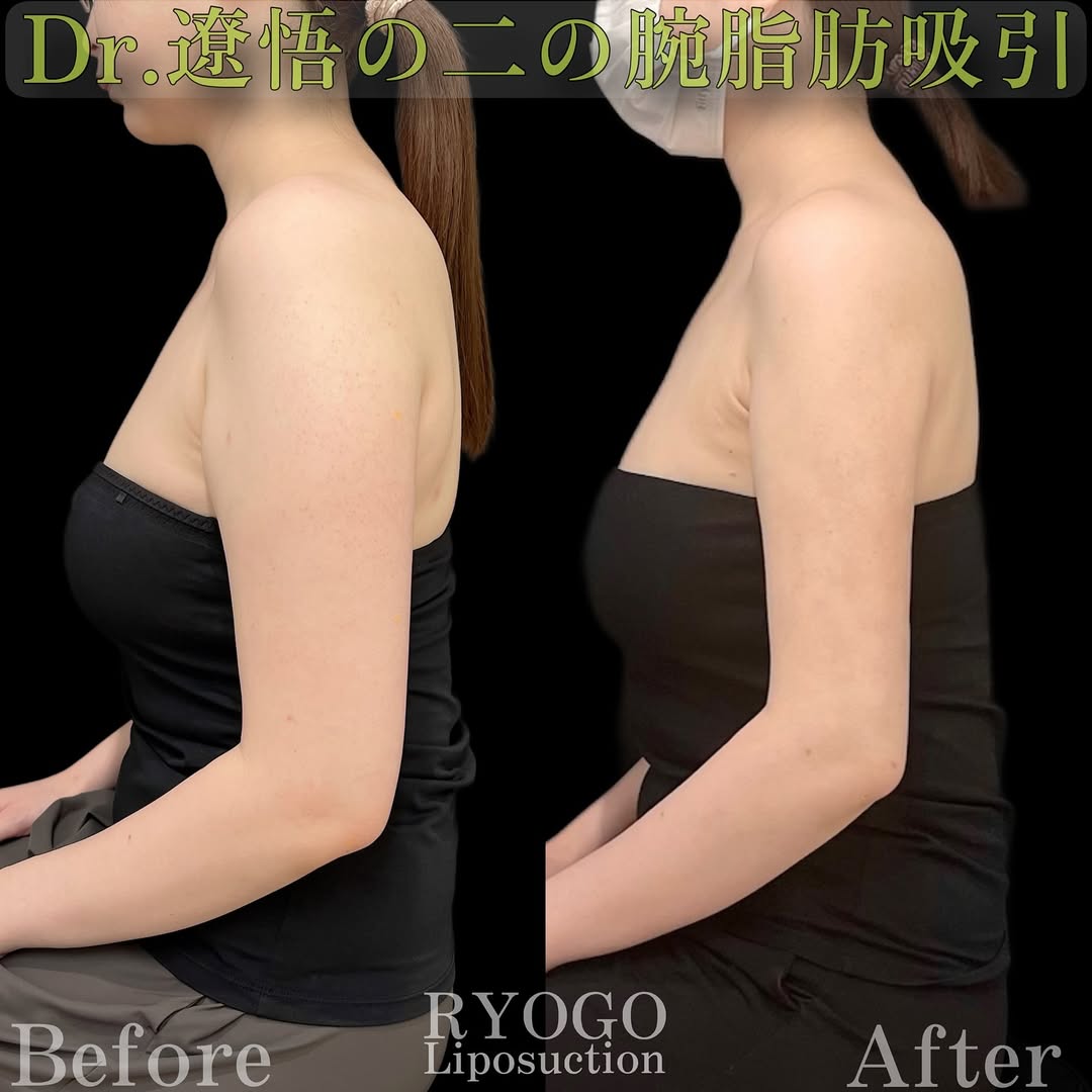 症例写真③【後ろ姿もスッキリ華奢見せ】