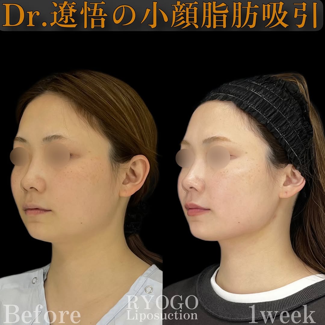 症例写真⑤【1週間でここまで変われる】