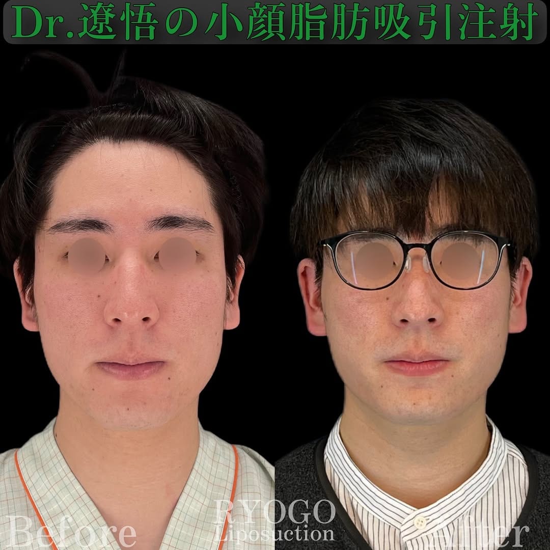 症例写真⑦【さらにカッコよく、メンズ小顔術】