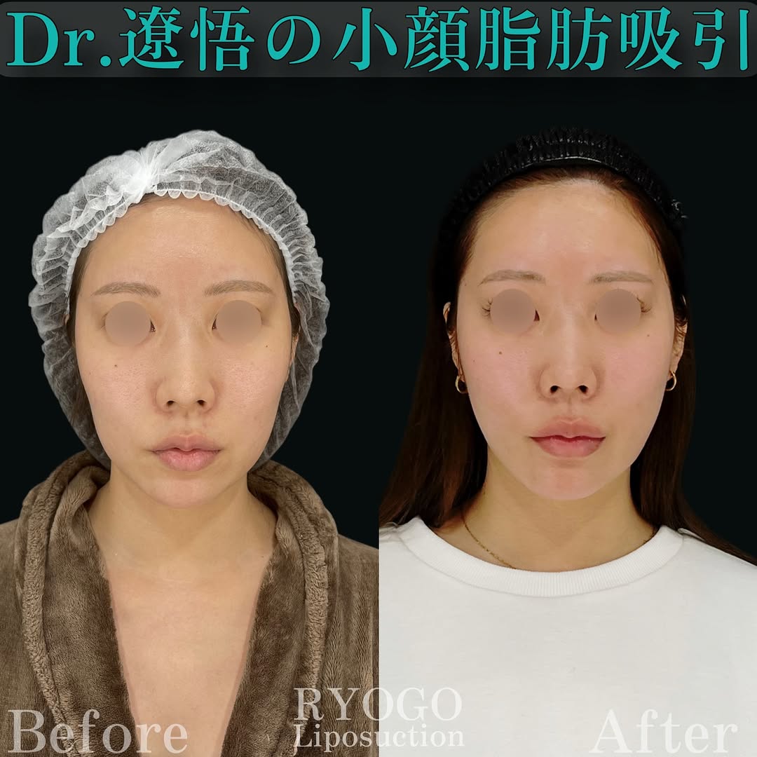 症例写真④【1時間で一生物のフェイスラインへ】