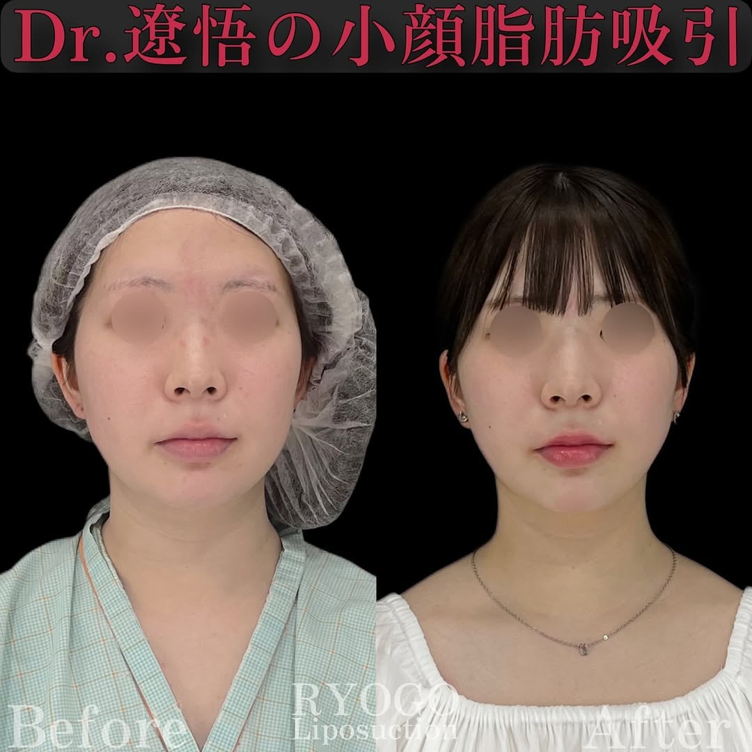 症例写真②【この変化、1ヶ月】