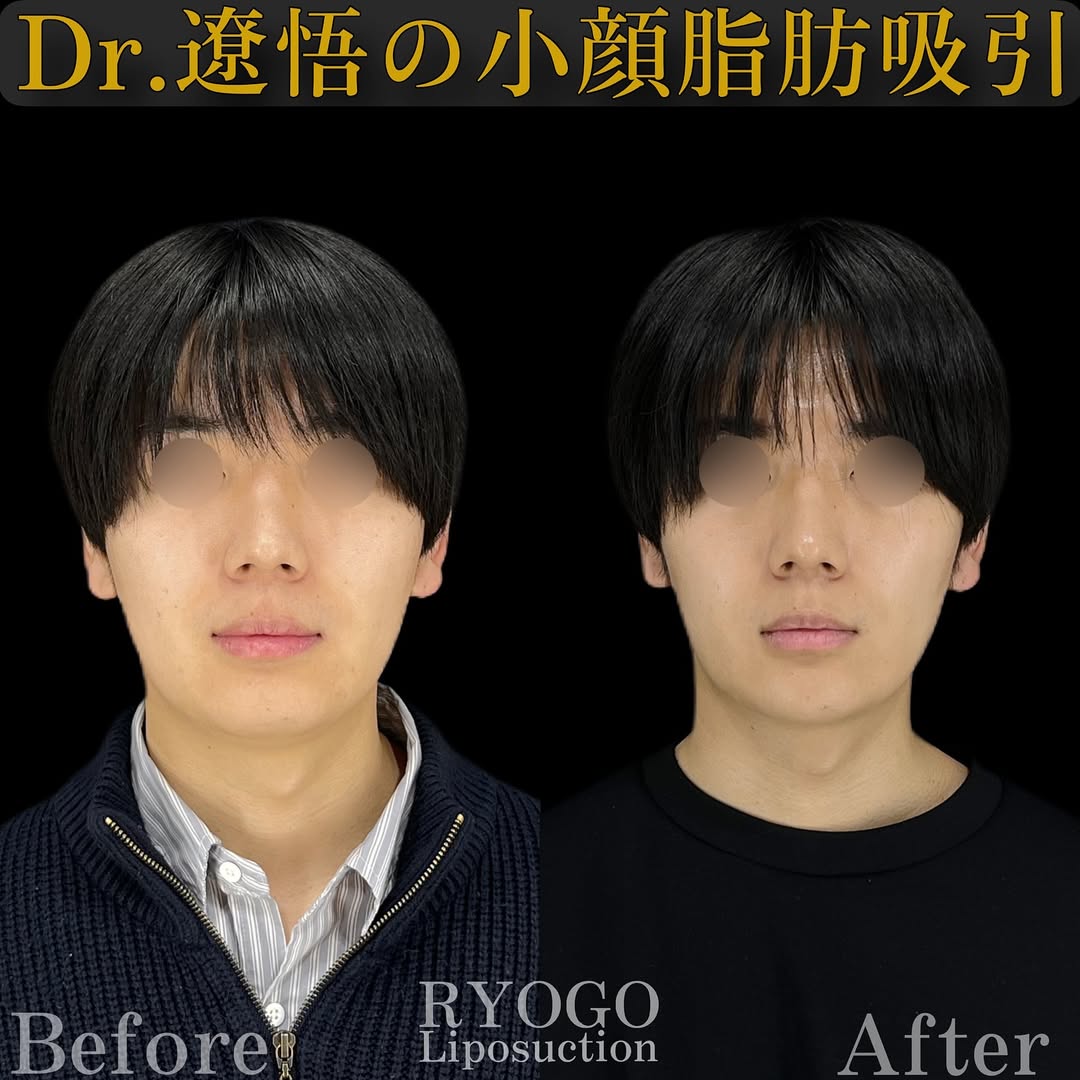 症例写真⑥【男を磨く、サクションリフト】