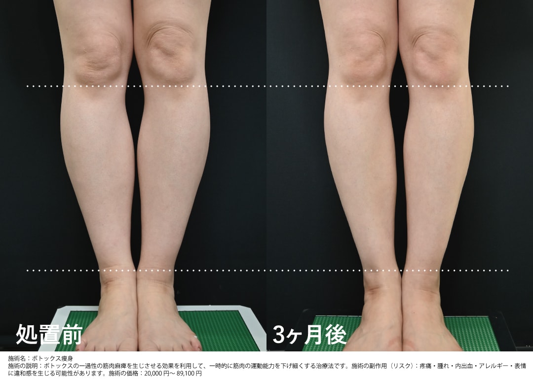 痩身ボトックス