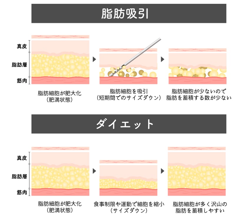 顔の脂肪吸引とは