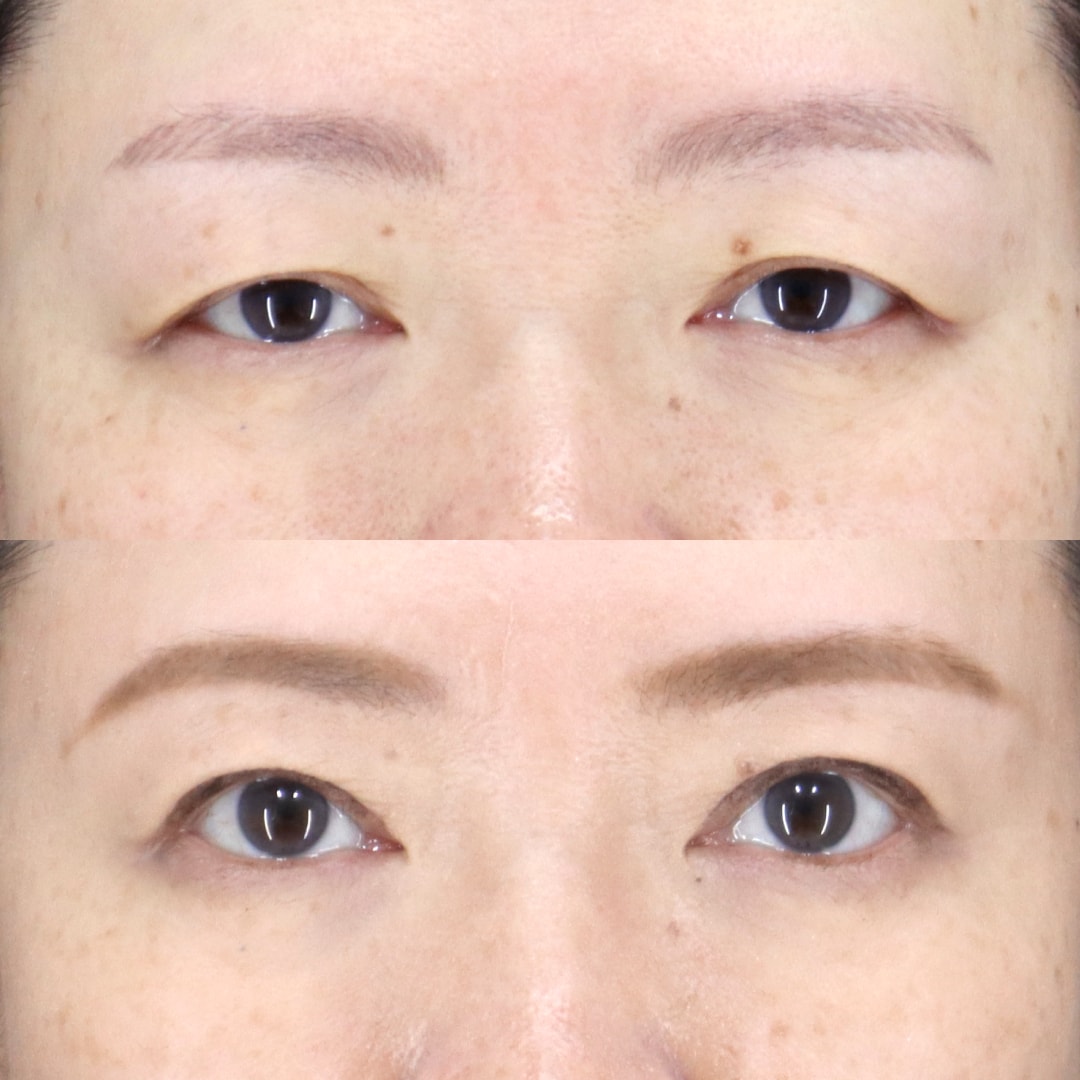 眉下リフト＋眼瞼下垂＋たるみ取り併用全切開二重術＋他院抜糸 術後6ヶ月