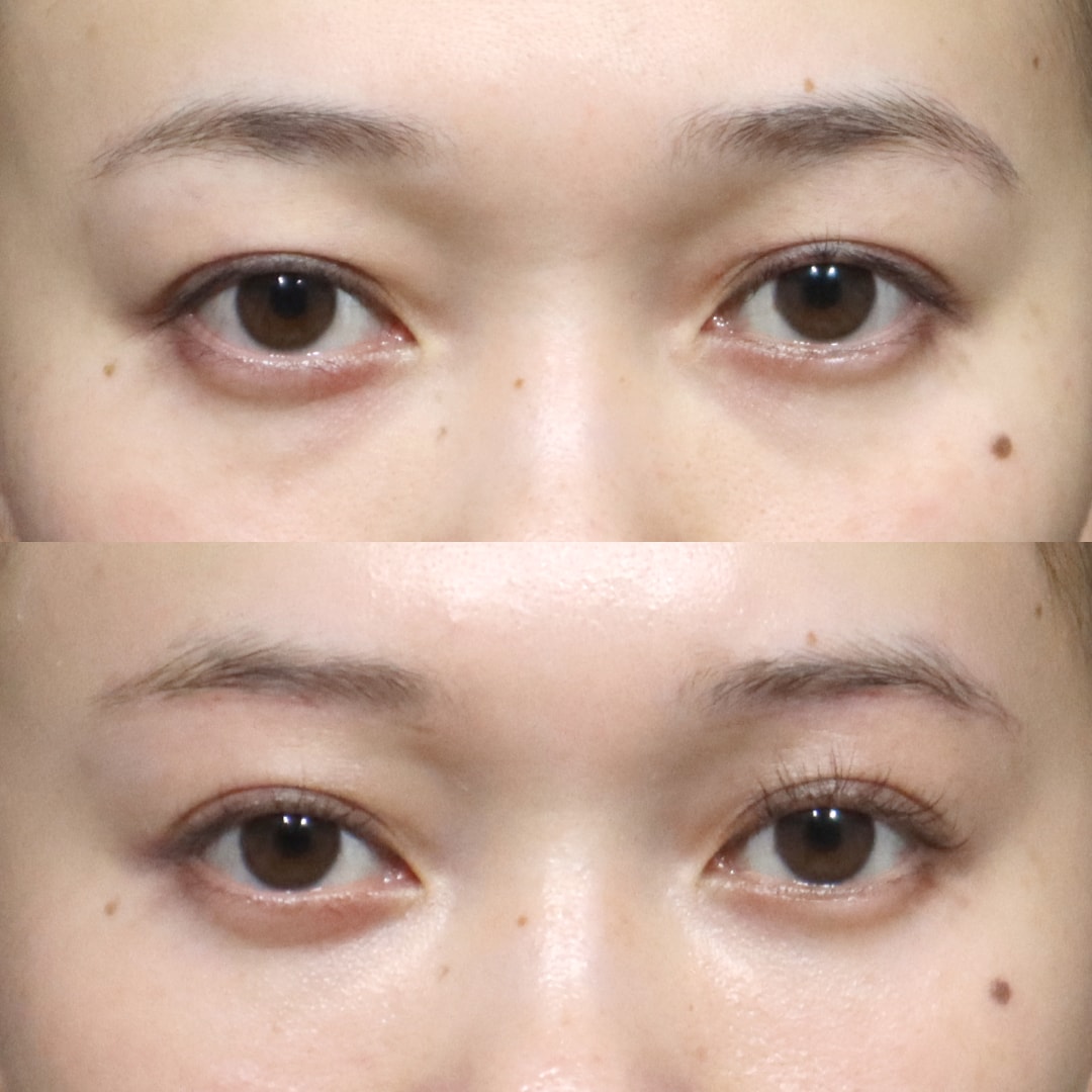 眉下リフト＋裏ハムラ(ミニマムダウンタイム式) 術後3ヶ月後
