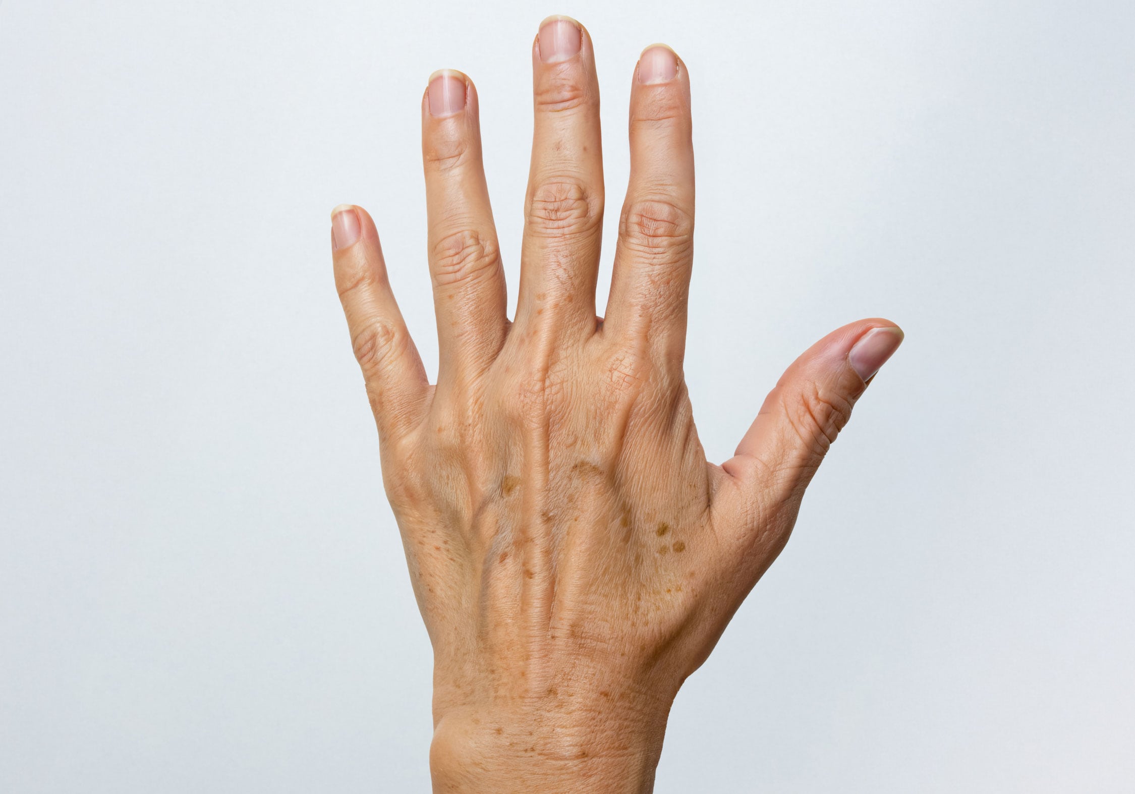 もう隠さない！手の甲のシミなら「シミ取りボディ」