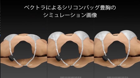 VectraH2とエコーを用いた科学的な術前術後評価