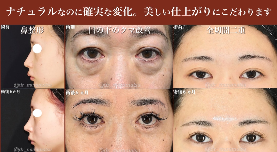 あくまで自然に。一度の手術で満足していただける仕上がり