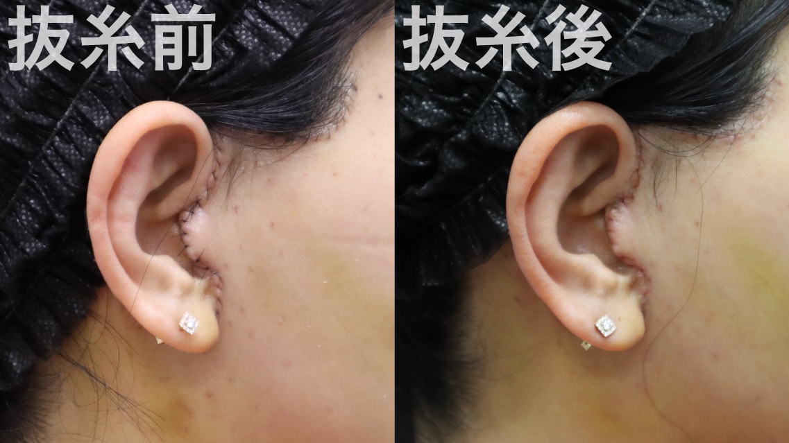 美しい縫合だから、傷跡も目立たない