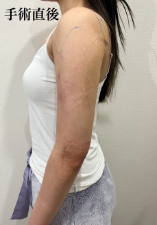 ②脂肪吸引よりダウンタイムが少ない