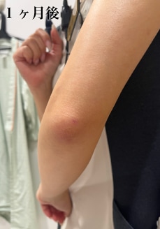 ③傷跡が小さい