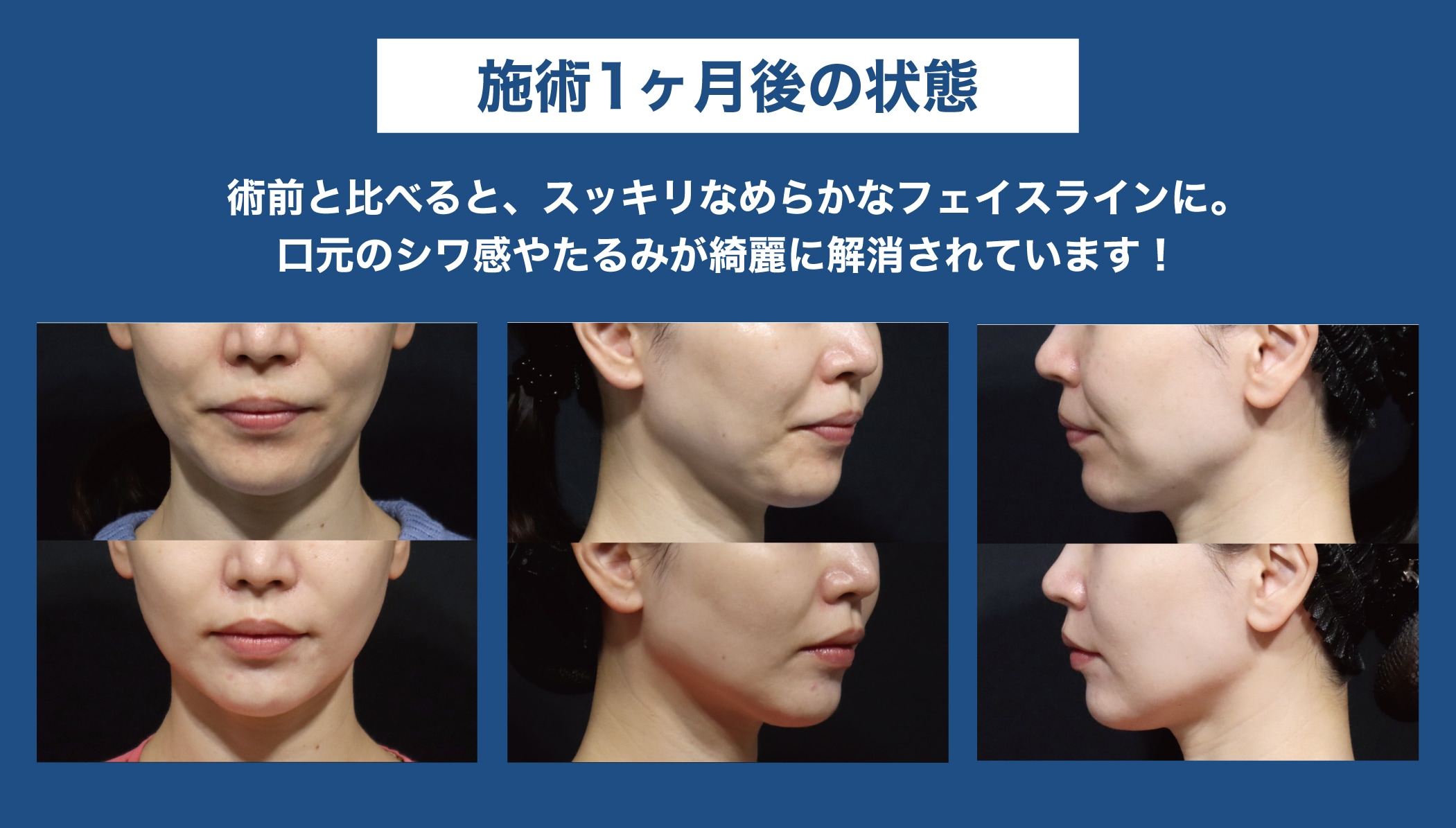 ◼️施術後１か月◼️