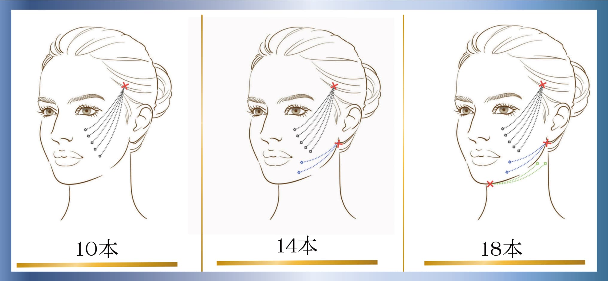 糸の挿入イメージ