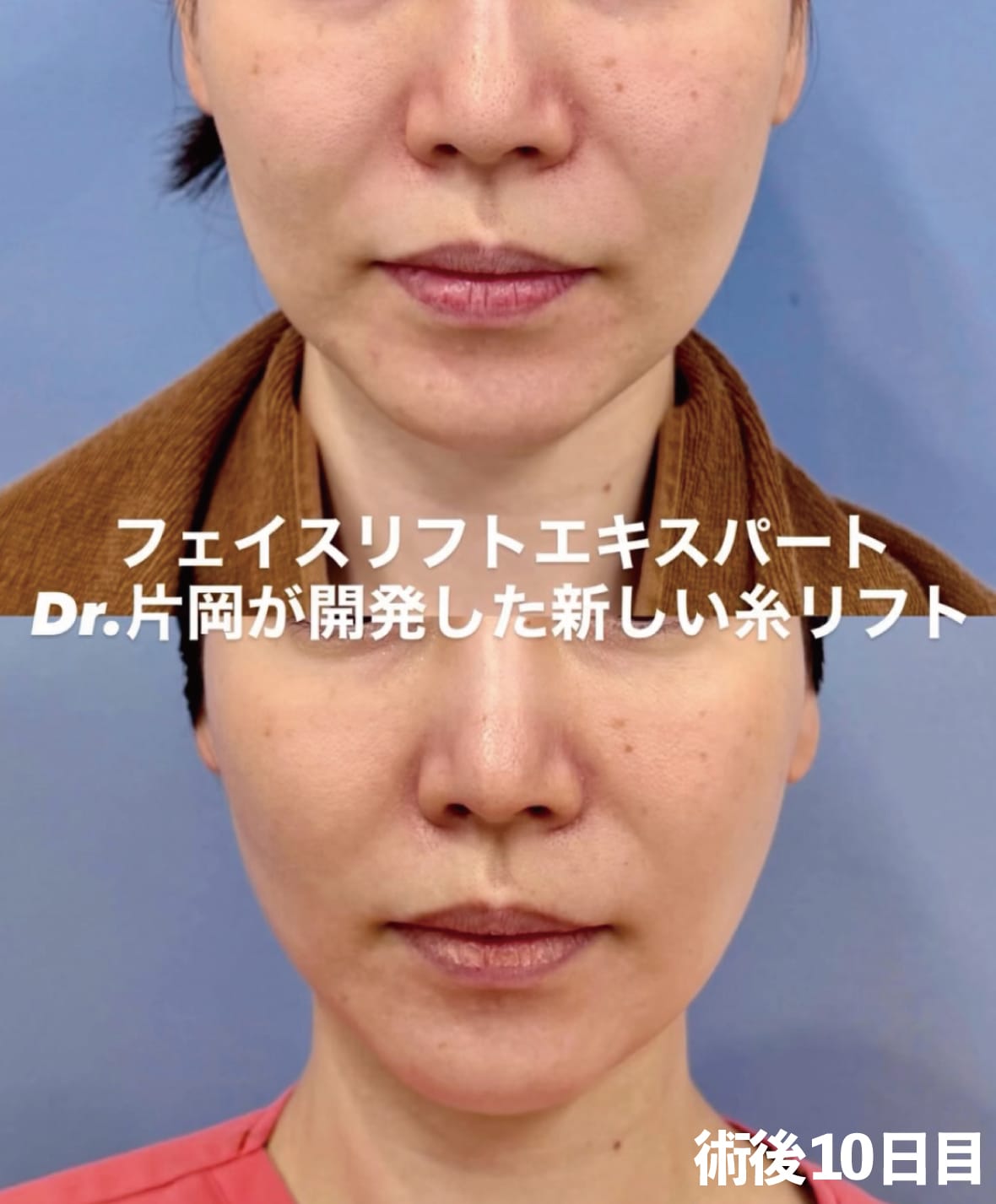 ◼️術後10日目◼️