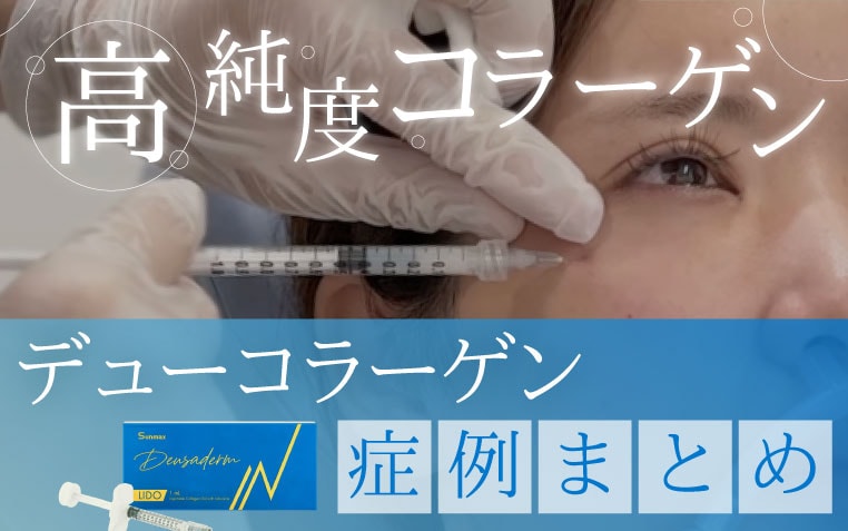 デューコラーゲン症例まとめ【目元へ高純度コラーゲン】