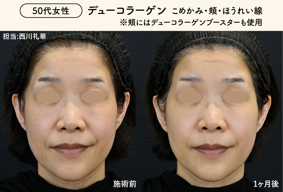 50代女性　こめかみ・頬・ほうれい線