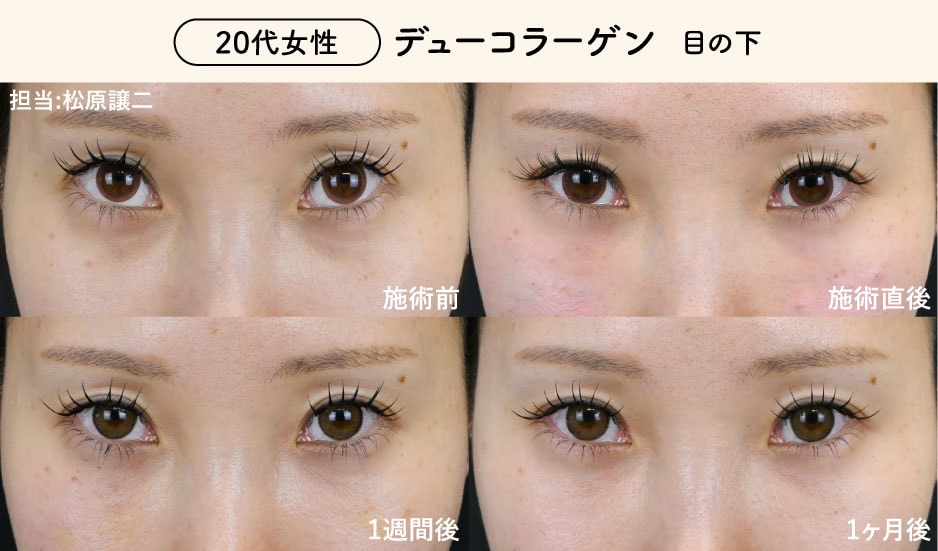 デューコラーゲンのダウンタイム