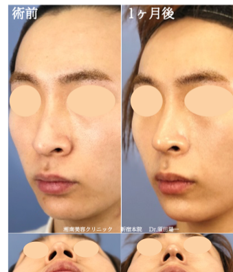 鼻尖形成3D法の症例