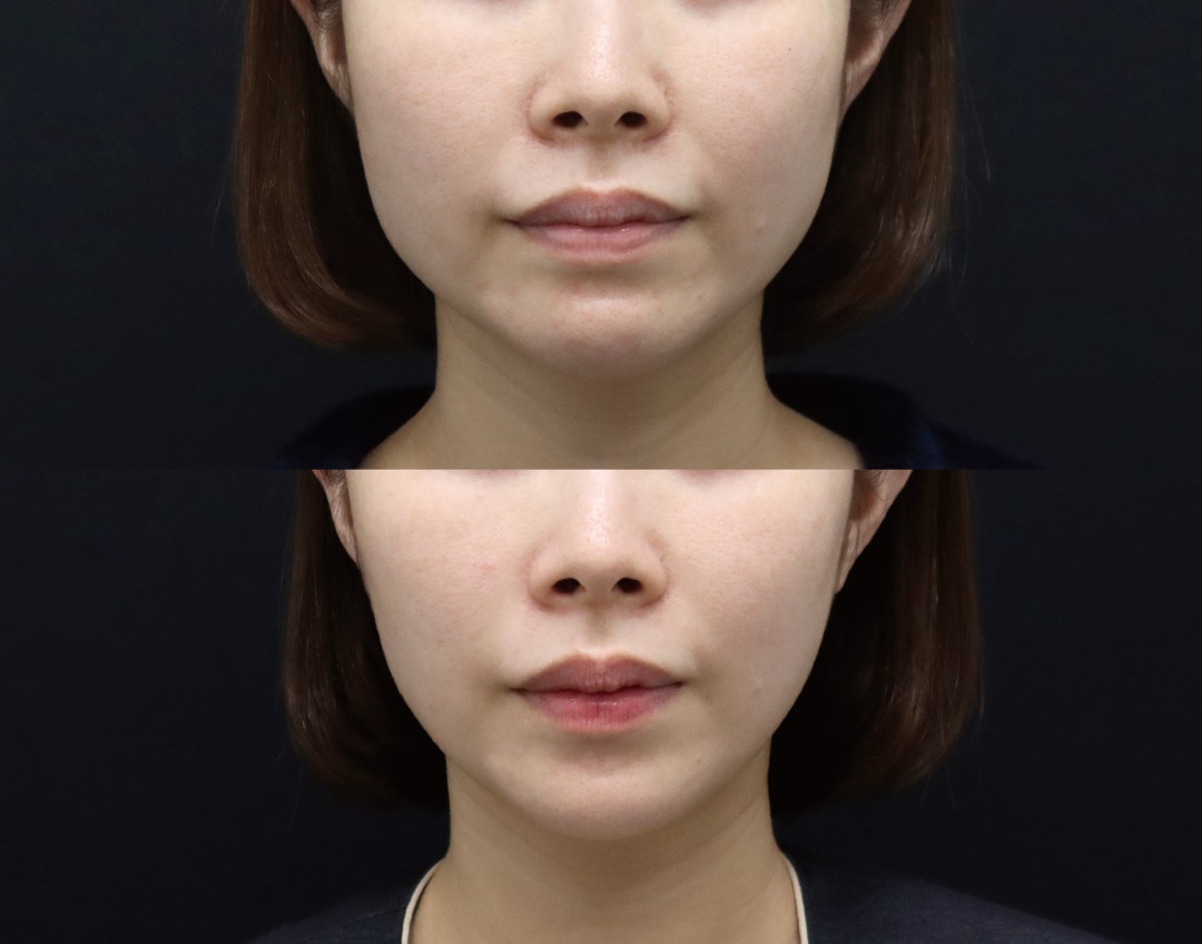 30代女性 1ヶ月後