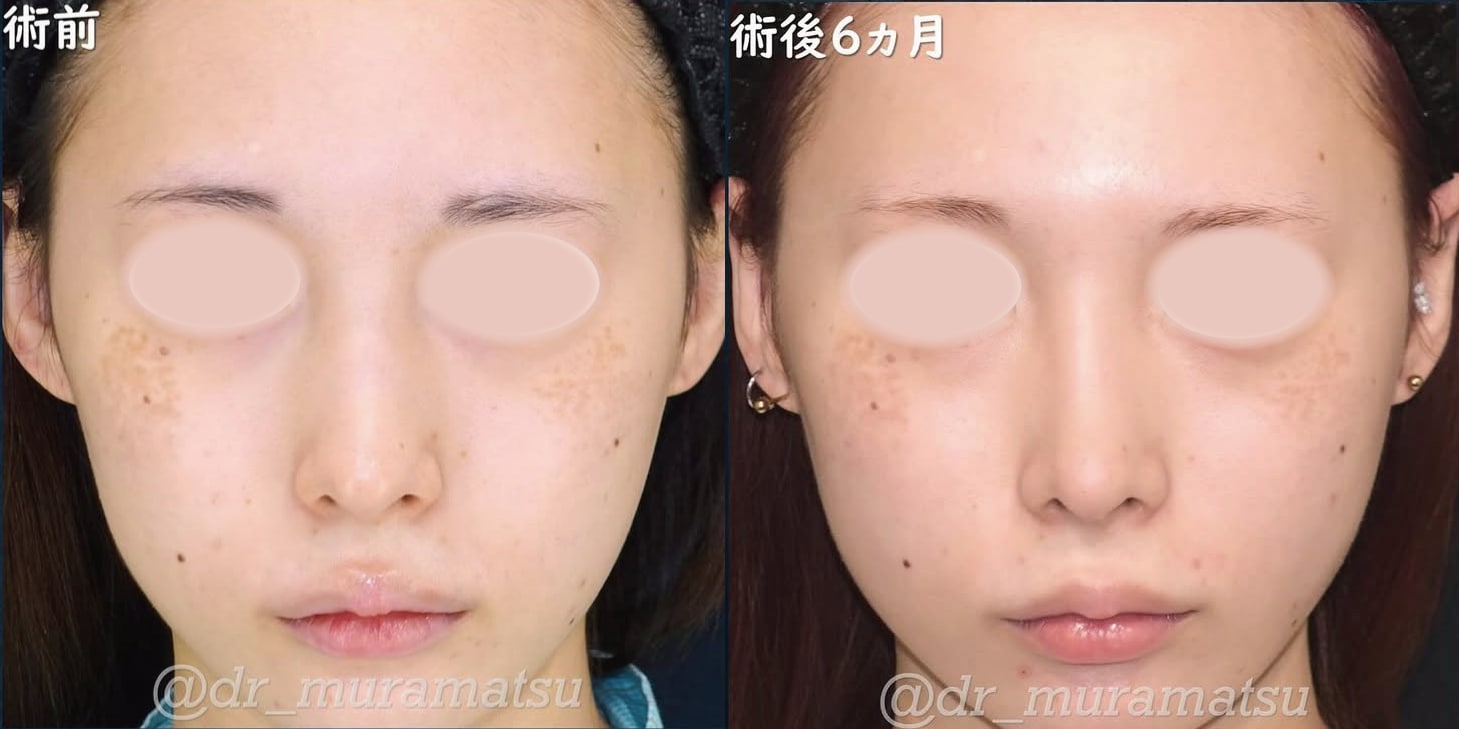 正面からの比較写真：鼻筋をよりシュッとした印象に。