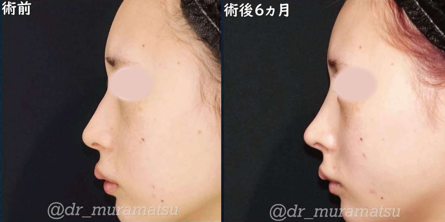 横からの比較写真：あくまで自然なアップノーズに。