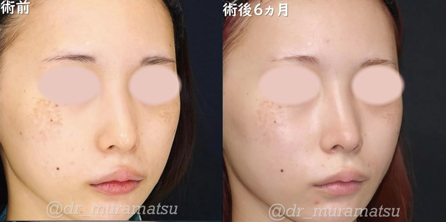 斜めからの比較写真：控えめだけど確実な変化でスッキリとした印象に。