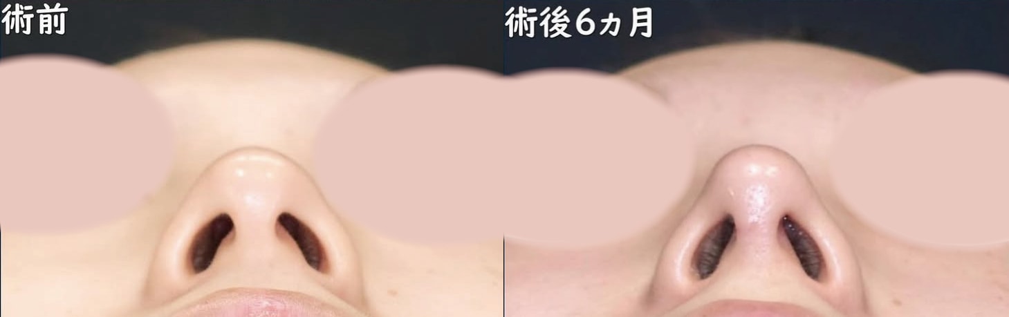 下からの比較写真：小鼻縮小をしなくても、小さくなった印象に。