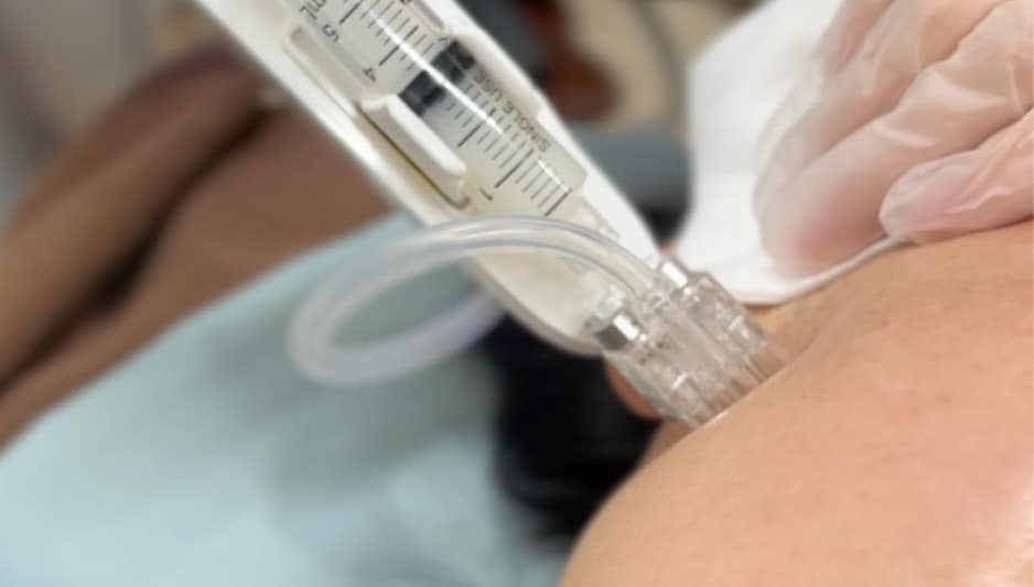 デューコラーゲン水光注射とは