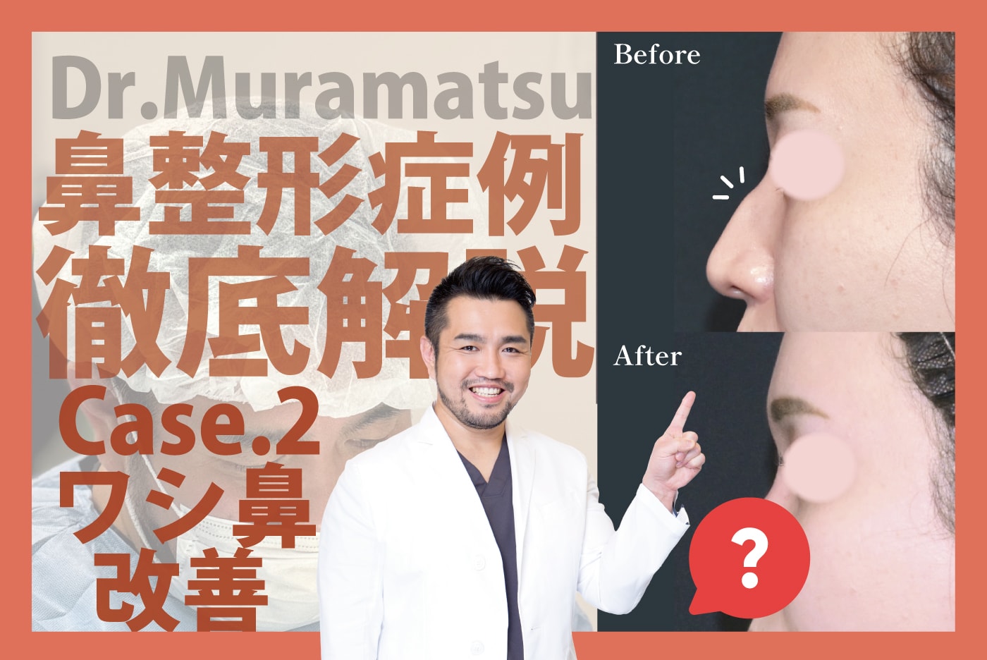 【鼻の巧】新宿本院 村松先生の鼻整形ビフォーアフター徹底解説！【ワシ鼻】をシュッとシャープ鼻にする鼻フル整形［東京エリアで鼻整形ならSBC新宿本院/失敗したくない貴方へ］