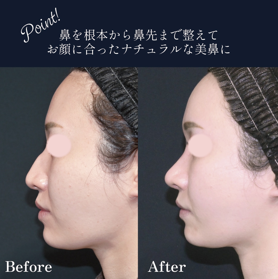 横からの比較写真：気になっていたワシ鼻を自然に改善。