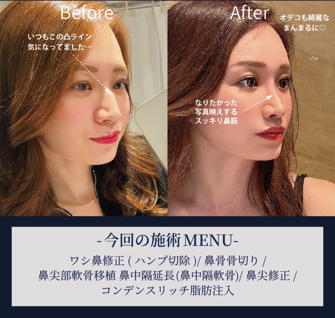 メイクありの写真：写真映えを叶えるシャープな鼻に。