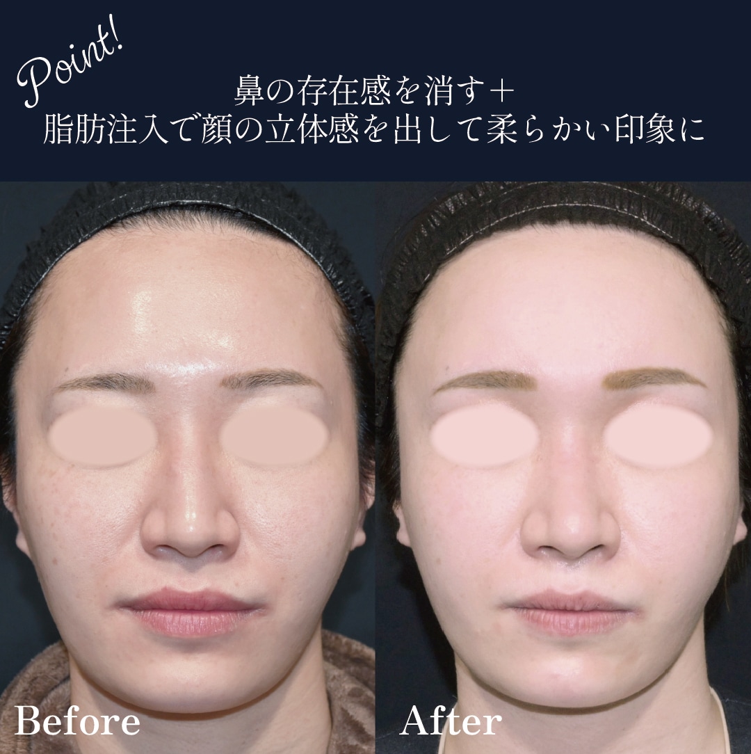 正面からの比較写真：忘れ鼻で顔のパーツを際立たせる。
