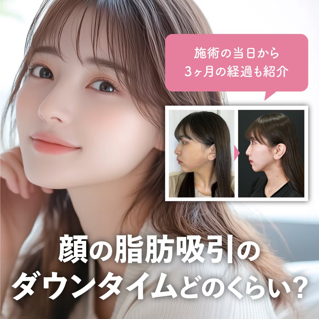顔の脂肪吸引のダウンタイムはどのくらい?施術当日〜3ヶ月の経過を追ってみた