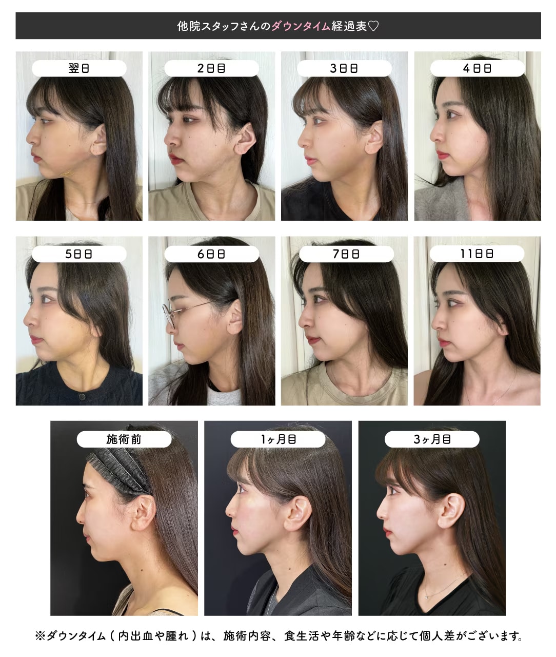 小野先生が執刀したスタッフさんの術前から3ヶ月後の経過を見よう